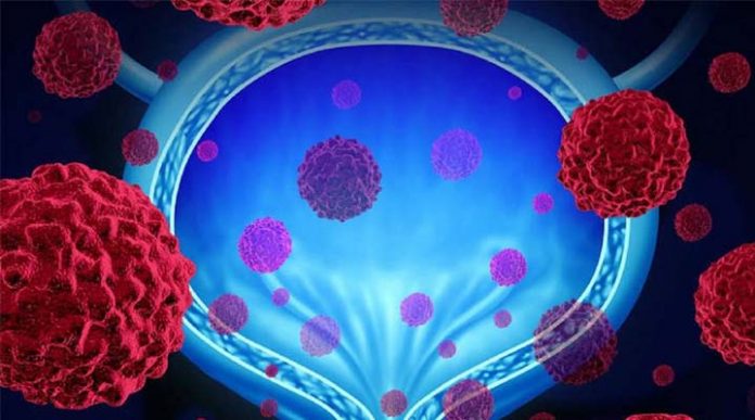 cáncer de vejiga Cáncer de vejiga