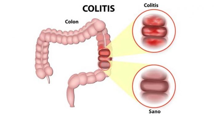 colitis