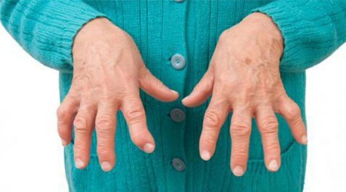 artritis