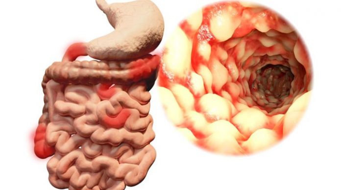 enfermedad de Crohn