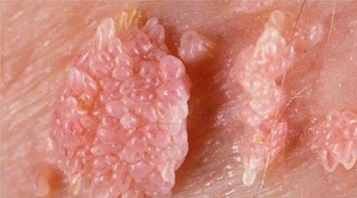 papiloma humano