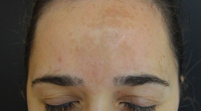 Melasma