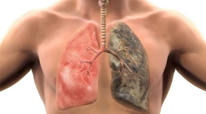 Cáncer de pulmon cáncer de pulmón