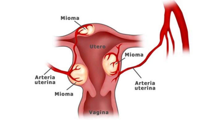 Miomatosis uterina Miomatosis uterina