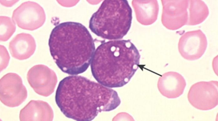 leucemia
