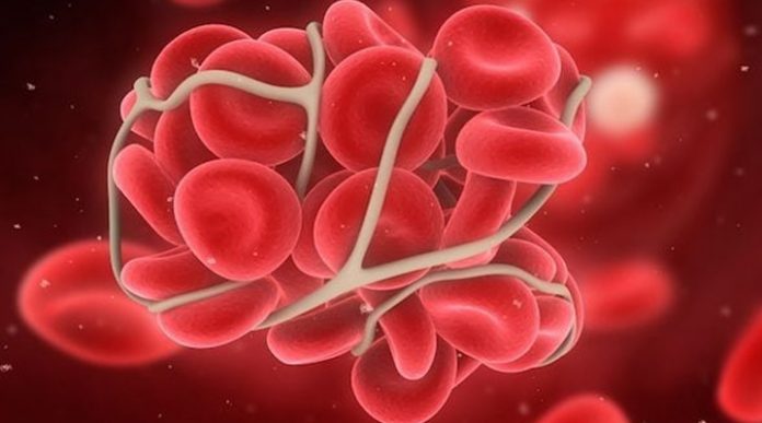 síndrome antifosfolipídico síndrome antifosfolipídico
