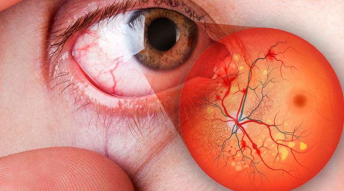 retinopatía diabética