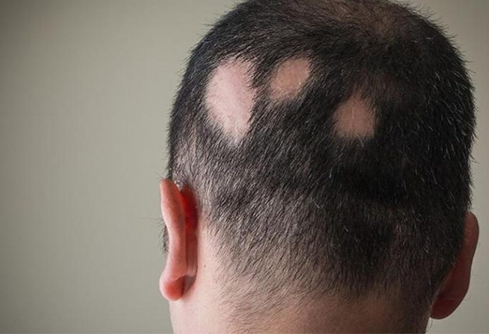alopecia alopecia