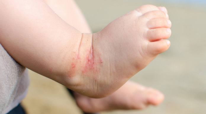 dermatitis