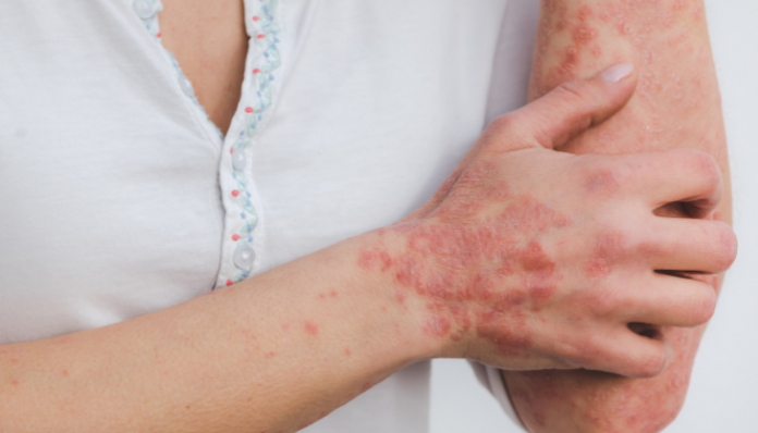 psoriasis