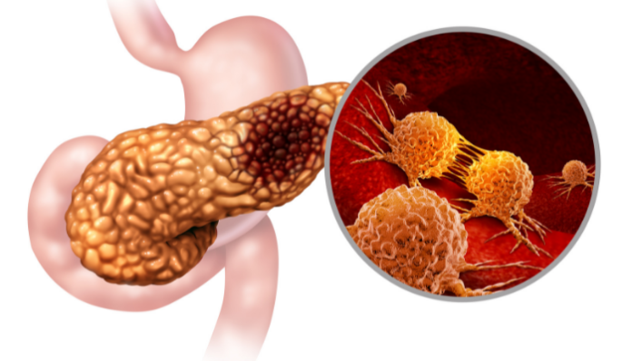 cáncer de páncreas páncreas