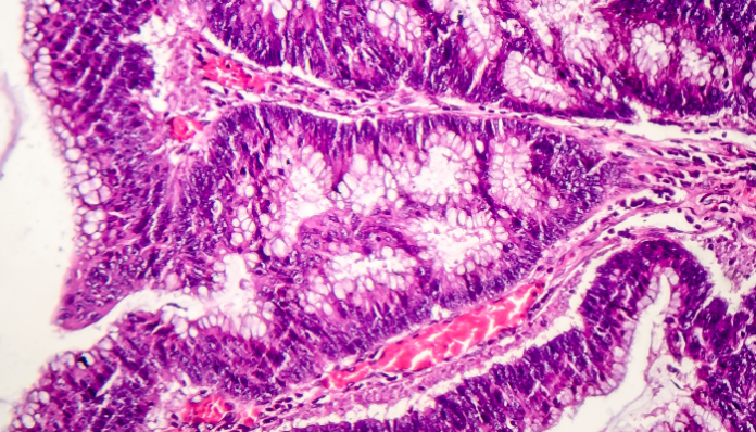 cáncer colon (1)