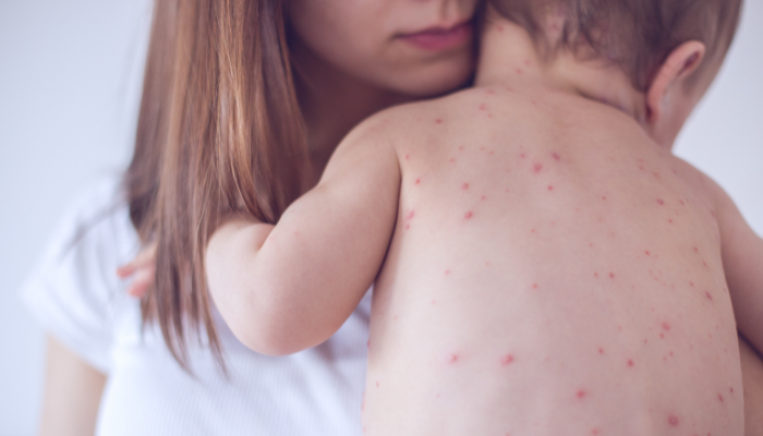 Sarampión: síntomas a estar alertas y la importancia de la vacunación